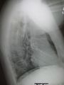 Normal lateral CXR