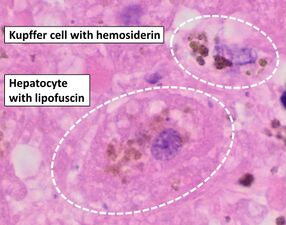 التشريح المرضي للكبد، يظهر خلية كوپفر مع ترسب هيموسديرين واضح بجوار خلية كبدية مع صبغة ليپوفوسين. لطخة H&E.
