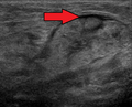 Submandibular gland inflammation as seen on ultrasound