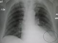 AP CXR showing left lower lobe pneumonia associated with a small left sided pleural effusion