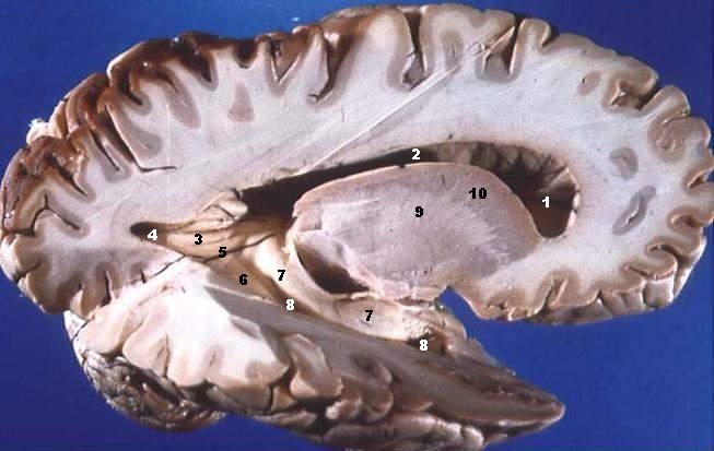 ملف:Human brain right dissected lateral view description.JPG