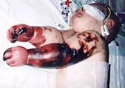 Charlotte Cleverley-Bisman Meningicoccal Disease.jpg