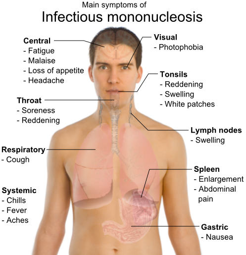 ملف:Main symptoms of Infectious mononucleosis.png