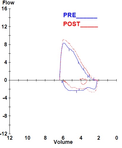 ملف:Normal Spirometry Chart.jpg