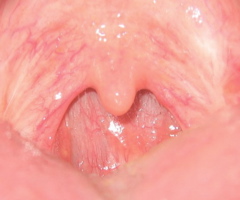 ملف:Uvula without tonsils.jpg