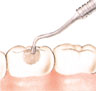 ملء الفجوة. يقوم طبيب الأسنان بوضع الحشوة داخل الفجوة باستخدام أداة أخرى. تترك الحشوة بعد ذلك لتتصلب.