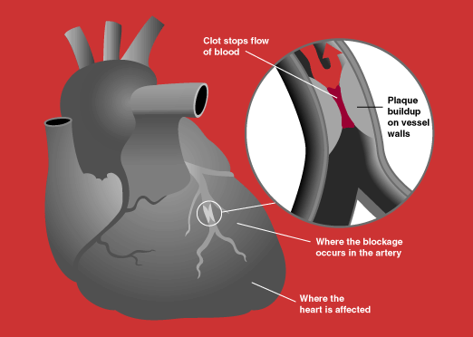 ملف:Heart attack diagram.png