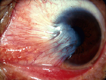 Pterygium (from Michigan Uni site, CC-BY).jpg