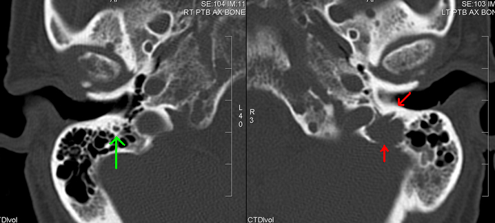 ملف:Multiple myeloma skull CT arrows.PNG