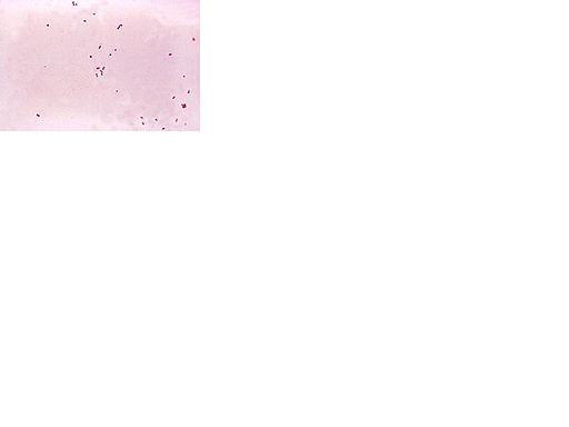 Gram stain of meningococci from a culture showing Gram negative (pink) bacteria, often in pairs