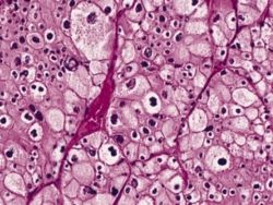 ملف:Renal Cell Carcinoma.jpg