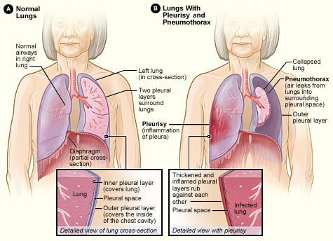 ملف:Pleurisy and pneumothorax.jpg