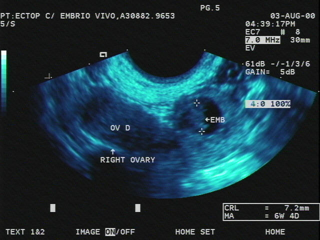 ملف:OB 1 Abnormal Ectopic Pregnancy.jpg
