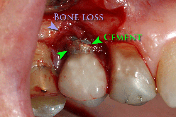 ملف:Periimplantitis due to dental cement.gif