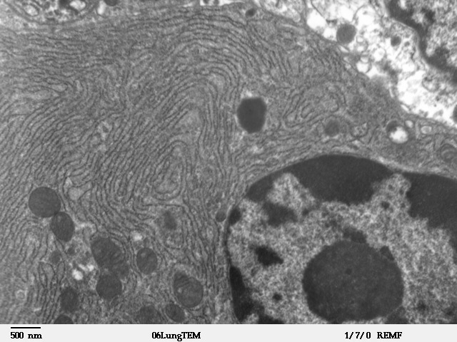 ملف:Clara cell lung - TEM.jpg