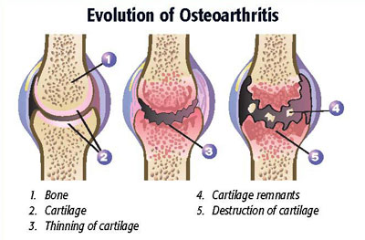 ملف:Evolution of Osteoarthritis.jpg