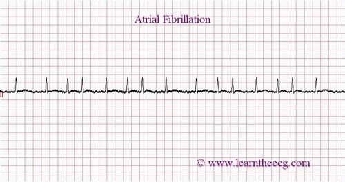 ملف:Atrial Fibrillation on ECG.jpg