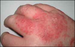 Dermatitis.jpg