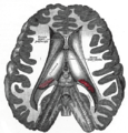 Dissection showing the ventricles of the brain