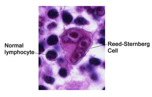 Reed-Sternberg lymphocyte nci-vol-7172-300.jpg