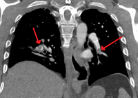 Segmental and subsegmental pulmonary emboli on both sides