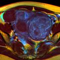 MRI image with multiple uterine leiomiyomas