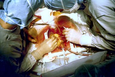 Coronary artery bypass surgery Image 657B-PH.jpg