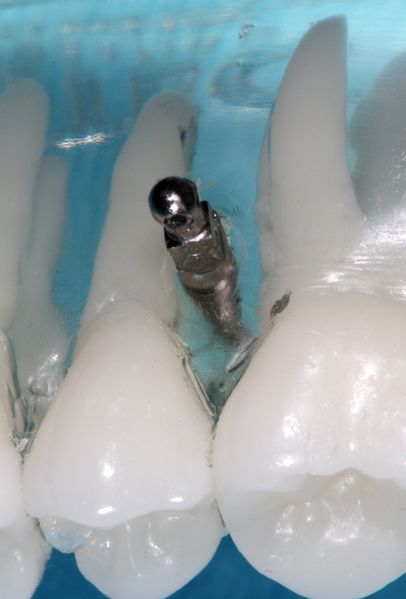 ملف:Implant orthodontic anchor model.jpg