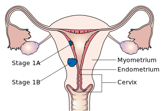 المرحلة 1أ وأ1 من سرطان بطانة الرحم.