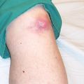 a reddened swelling on a knee; the middle part is pale with a circular raised centre