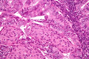Image of the histology of an endometrioid endometrial adenocarcinoma