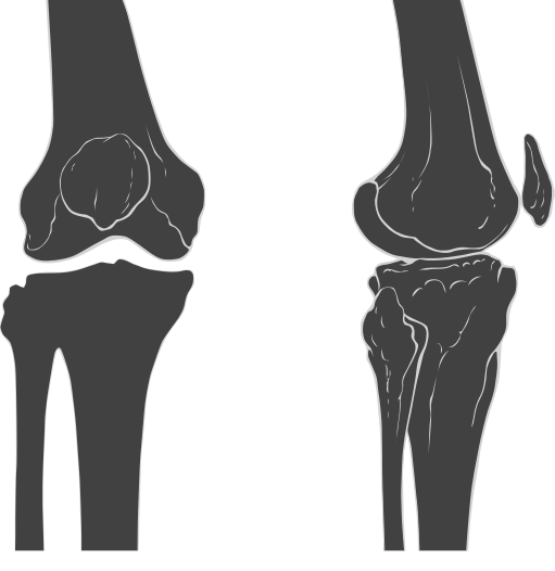 ملف:Knee skeleton lateral anterior views.svg