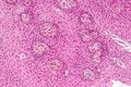 صورة مجهرية تظهر ورم قحفي بلعومي حليمي ، صبغة الهيماتوكسيلين فلوكسين الكركمية اللون