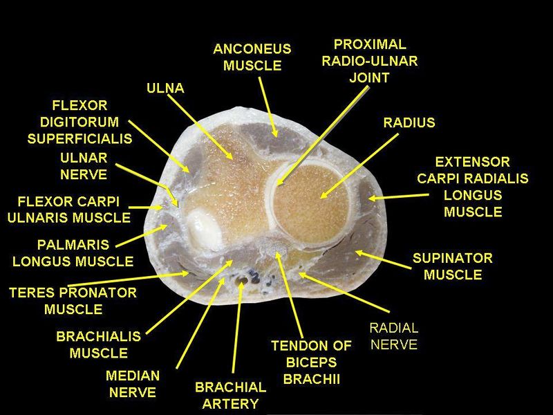 ملف:Muscles of upper limb.(cross section - human cadaver).jpg
