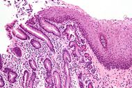Pancreatic acinar metaplasia - high mag.jpg