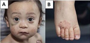 Wiskott–Aldrich syndrome petechiae, hematoma and eczema.jpg