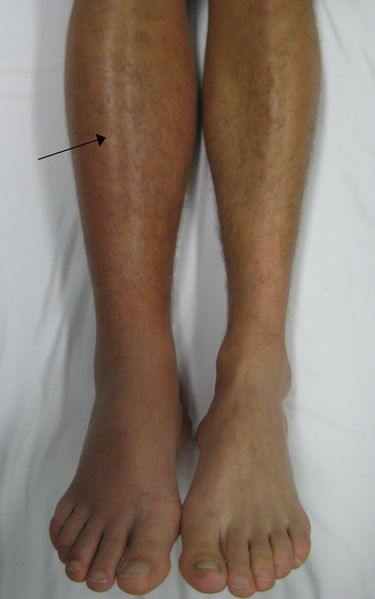 ملف:Deep vein thrombosis of the right leg.jpg