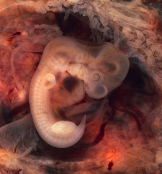 ملف:Tubal Pregnancy with embryo.jpg