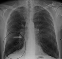 فقاعة رئة كما تبدو عند تصوير الصدر بالأشعة السينية لدى شخص يعاني من داء الانسداد الرئوي المزمن الحاد