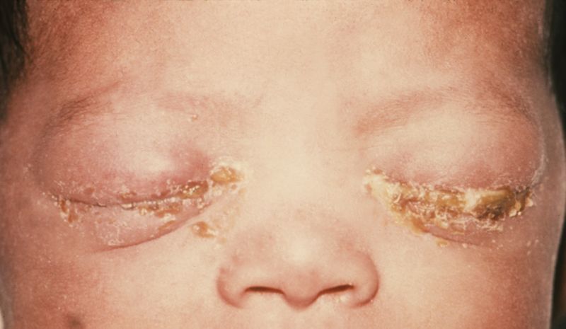 ملف:Gonococcal ophthalmia neonatorum.jpg