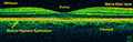 المجال الزمني (التصوير المقطعي المتسق البصري) للمنطقة البقعية لشبكية العين عند 800 نانومتر ، دقة محورية 3 ميكرومتر