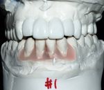 Sometimes the final position and restoration of the teeth will be simulated on plaster models to help determine the number and position of implants needed.