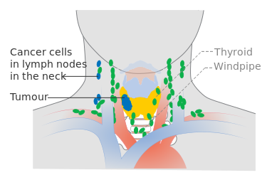 ملف:Diagram showing stage N1b thyroid cancer CRUK 243.svg
