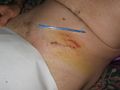 Old & new hernia scars 2009