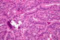 Micrograph of papillary thyroid carcinoma, tall cell variant - high magnification. H&E stain.