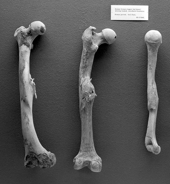 ملف:Paleopathology; Human femurs from Roman period, Tell Fara Wellcome L0008764.jpg