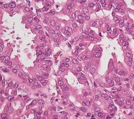 Histopathology of pancreatobiliary intraductal papillary mucinous neoplasm in the pancreas.jpg