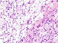 Micrograph of a myxoid liposarcoma, H&E stain
