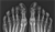 X-ray of symphalangism of fifth toes.png