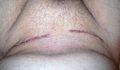Bilateral Hernia scars 7 days after surgery